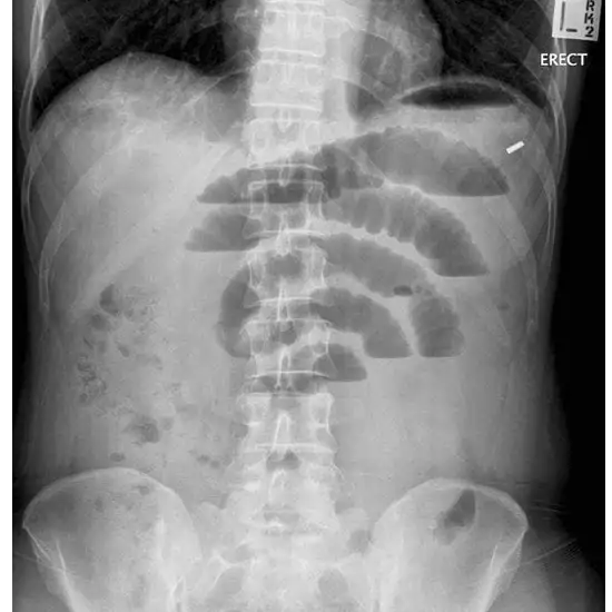 X-ray Abdomen Erect